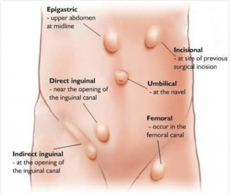 Hérnia inguinal: o que é, sintomas e tratamento
